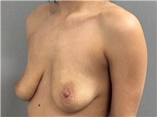 Breast Lift Before Photo by Keshav Magge, MD; Bethesda, MD - Case 51250