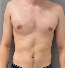 Male Breast Reduction After Photo by Keshav Magge, MD; Bethesda, MD - Case 51249