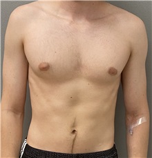 Male Breast Reduction Before Photo by Keshav Magge, MD; Bethesda, MD - Case 51249