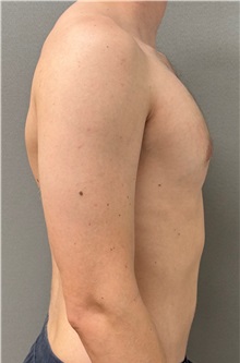 Male Breast Reduction After Photo by Keshav Magge, MD; Bethesda, MD - Case 51249