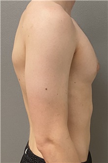 Male Breast Reduction Before Photo by Keshav Magge, MD; Bethesda, MD - Case 51249