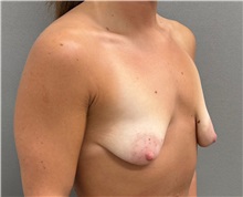 Breast Lift Before Photo by Keshav Magge, MD; Bethesda, MD - Case 51279
