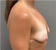 Breast Lift Before Photo by Keshav Magge, MD; Bethesda, MD - Case 51279