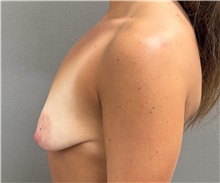 Breast Lift Before Photo by Keshav Magge, MD; Bethesda, MD - Case 51279