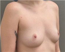 Breast Augmentation Before Photo by Keshav Magge, MD; Bethesda, MD - Case 51281