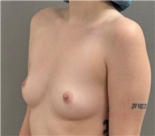 Breast Augmentation Before Photo by Keshav Magge, MD; Bethesda, MD - Case 51281