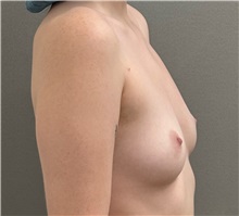 Breast Augmentation Before Photo by Keshav Magge, MD; Bethesda, MD - Case 51281