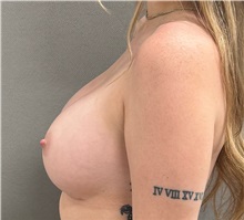 Breast Augmentation After Photo by Keshav Magge, MD; Bethesda, MD - Case 51281