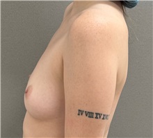 Breast Augmentation Before Photo by Keshav Magge, MD; Bethesda, MD - Case 51281
