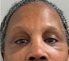 Brow Lift After Photo by Keshav Magge, MD; Bethesda, MD - Case 51282