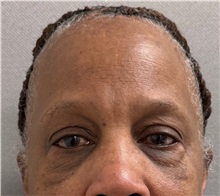 Brow Lift Before Photo by Keshav Magge, MD; Bethesda, MD - Case 51282