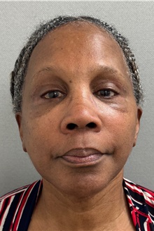 Facelift After Photo by Keshav Magge, MD; Bethesda, MD - Case 51377