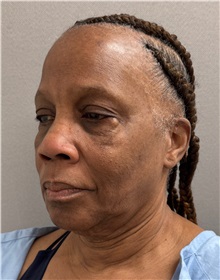 Facelift Before Photo by Keshav Magge, MD; Bethesda, MD - Case 51377