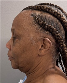 Facelift Before Photo by Keshav Magge, MD; Bethesda, MD - Case 51377