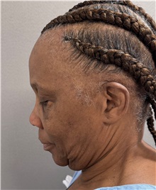 Facelift Before Photo by Keshav Magge, MD; Bethesda, MD - Case 51377