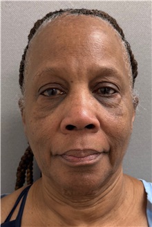Neck Lift Before Photo by Keshav Magge, MD; Bethesda, MD - Case 51376