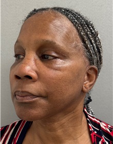 Neck Lift After Photo by Keshav Magge, MD; Bethesda, MD - Case 51376