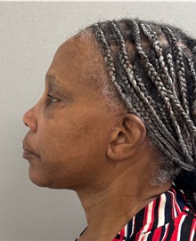 Neck Lift After Photo by Keshav Magge, MD; Bethesda, MD - Case 51376