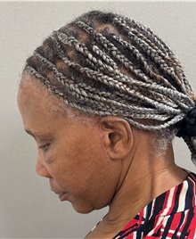 Neck Lift After Photo by Keshav Magge, MD; Bethesda, MD - Case 51376
