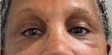 Eyelid Surgery After Photo by Keshav Magge, MD; Bethesda, MD - Case 51405