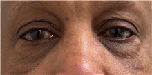Eyelid Surgery Before Photo by Keshav Magge, MD; Bethesda, MD - Case 51405