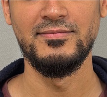 Cheek Reduction After Photo by Keshav Magge, MD; Bethesda, MD - Case 51406