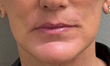 Lip Augmentation/Enhancement After Photo by Keshav Magge, MD; Bethesda, MD - Case 51415