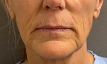 Lip Augmentation/Enhancement Before Photo by Keshav Magge, MD; Bethesda, MD - Case 51415