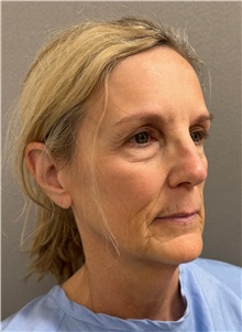Neck Lift Before Photo by Keshav Magge, MD; Bethesda, MD - Case 51418