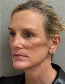 Neck Lift After Photo by Keshav Magge, MD; Bethesda, MD - Case 51418