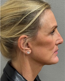 Neck Lift After Photo by Keshav Magge, MD; Bethesda, MD - Case 51418