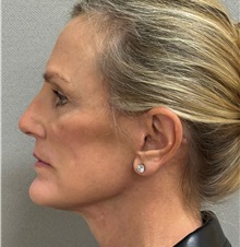 Neck Lift After Photo by Keshav Magge, MD; Bethesda, MD - Case 51418