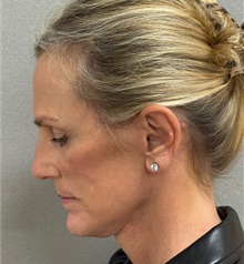 Neck Lift After Photo by Keshav Magge, MD; Bethesda, MD - Case 51418