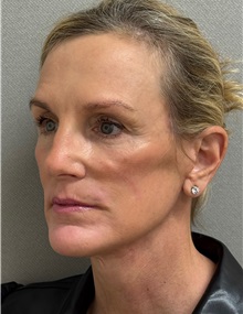 Facelift After Photo by Keshav Magge, MD; Bethesda, MD - Case 51419