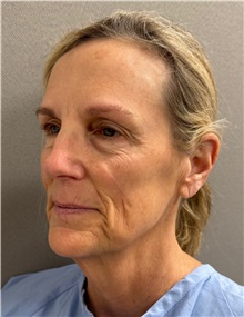 Facelift Before Photo by Keshav Magge, MD; Bethesda, MD - Case 51419