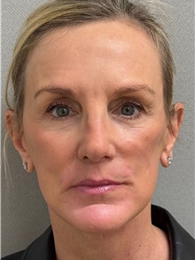 Facelift After Photo by Keshav Magge, MD; Bethesda, MD - Case 51419