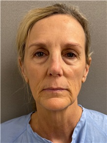 Facelift Before Photo by Keshav Magge, MD; Bethesda, MD - Case 51419