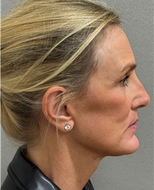 Facelift After Photo by Keshav Magge, MD; Bethesda, MD - Case 51419