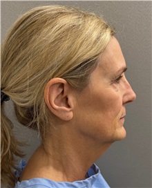 Facelift Before Photo by Keshav Magge, MD; Bethesda, MD - Case 51419