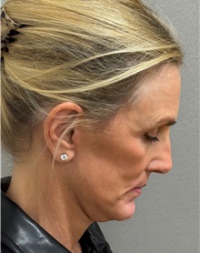 Facelift After Photo by Keshav Magge, MD; Bethesda, MD - Case 51419
