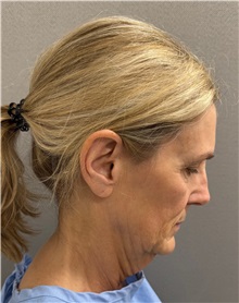 Facelift Before Photo by Keshav Magge, MD; Bethesda, MD - Case 51419