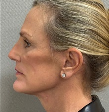 Facelift After Photo by Keshav Magge, MD; Bethesda, MD - Case 51419
