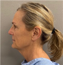 Facelift Before Photo by Keshav Magge, MD; Bethesda, MD - Case 51419