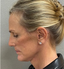 Facelift After Photo by Keshav Magge, MD; Bethesda, MD - Case 51419