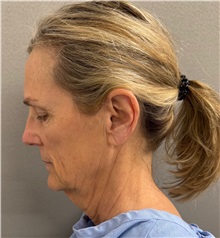 Facelift Before Photo by Keshav Magge, MD; Bethesda, MD - Case 51419