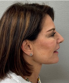 Facelift After Photo by Keshav Magge, MD; Bethesda, MD - Case 51431