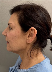 Facelift Before Photo by Keshav Magge, MD; Bethesda, MD - Case 51431