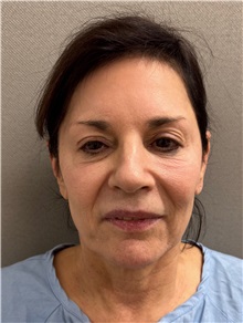 Facelift Before Photo by Keshav Magge, MD; Bethesda, MD - Case 51431