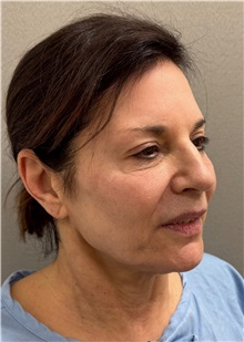 Neck Lift Before Photo by Keshav Magge, MD; Bethesda, MD - Case 51430