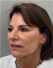 Neck Lift After Photo by Keshav Magge, MD; Bethesda, MD - Case 51430